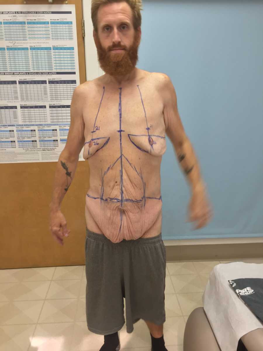 Man who had gastric bypass surgery stands shirtless with marks on his chest to remove saggy skin