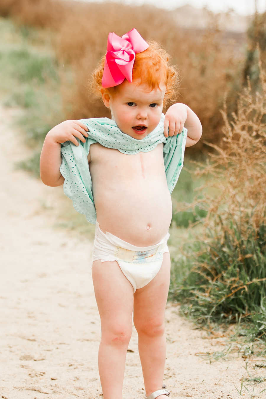 Toddler holds up dress to reveal open heart surgery scar on center of chest