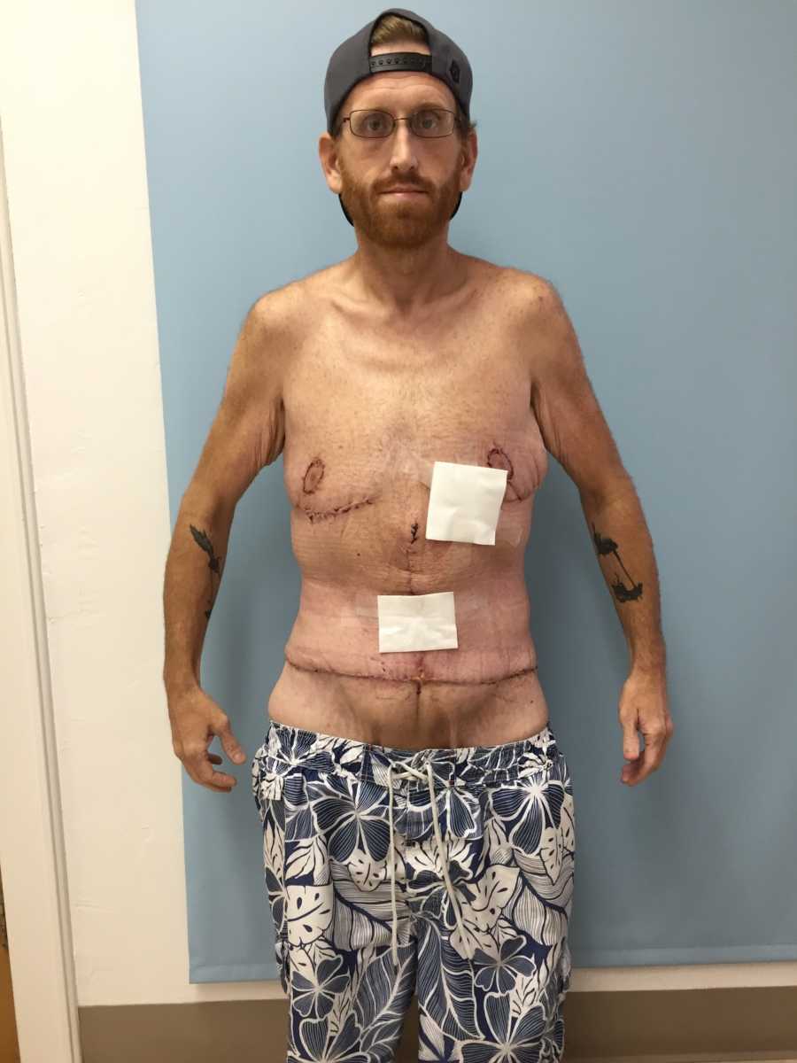 Man who had gastric bypass surgery stands shirtless after plastic surgery to get rid of sagging skin