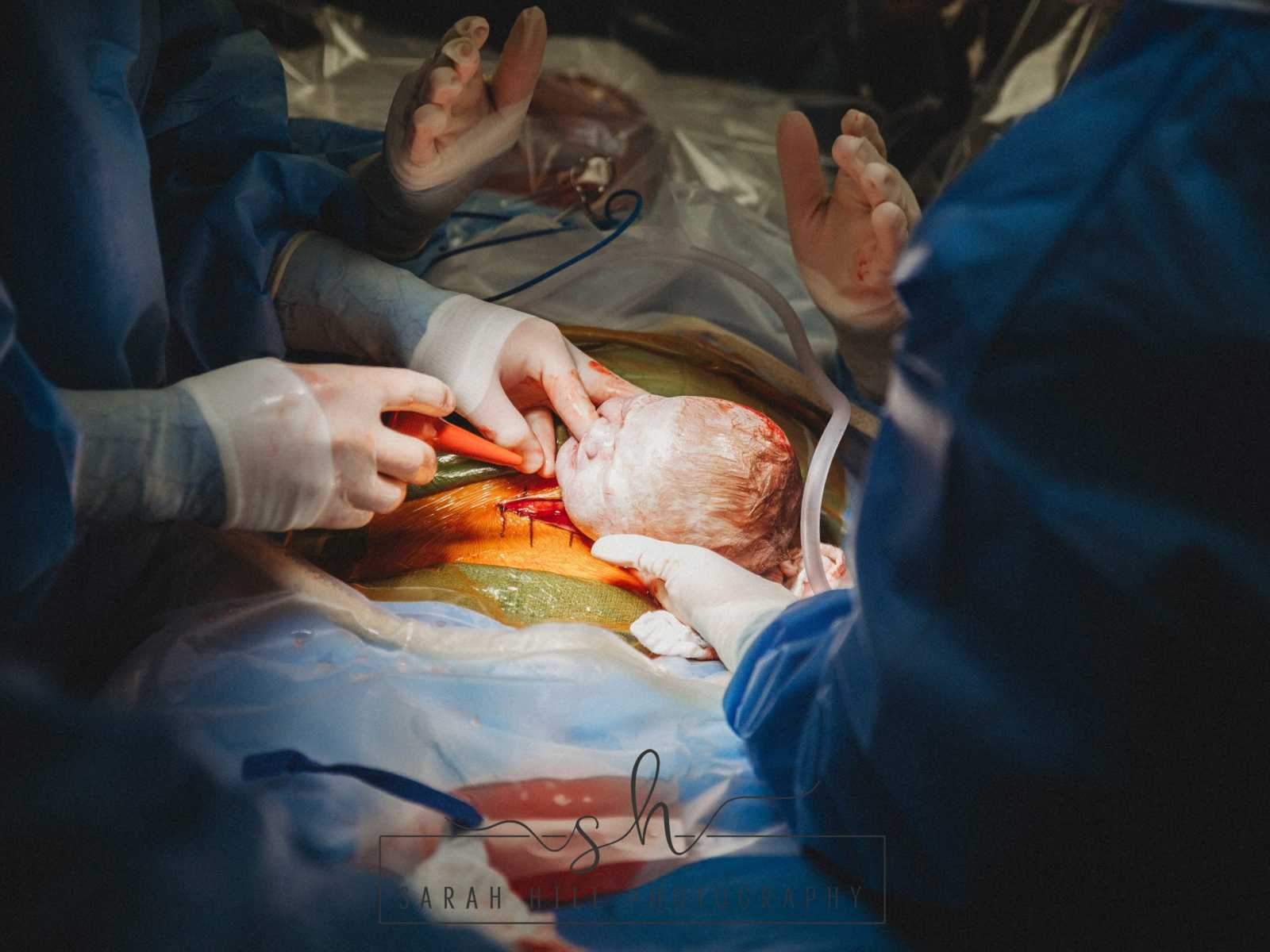 OBGYN performing a c-section operation and pulling baby's head out