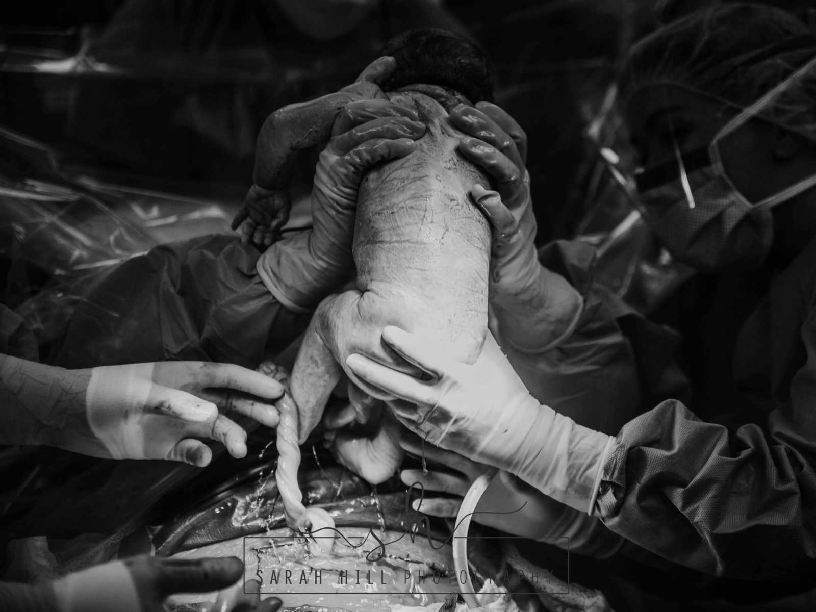 Mother who is also a midwife pulls baby out of her stomach during c-section