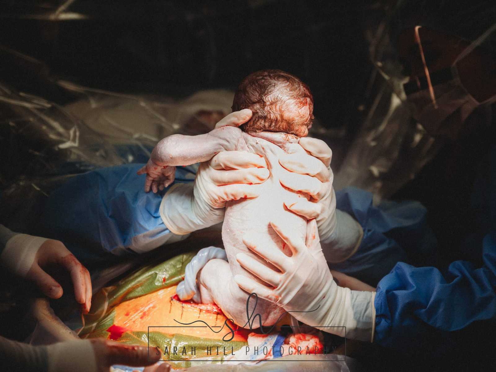 Mother who is also a midwife received a c-section pulls baby out herself