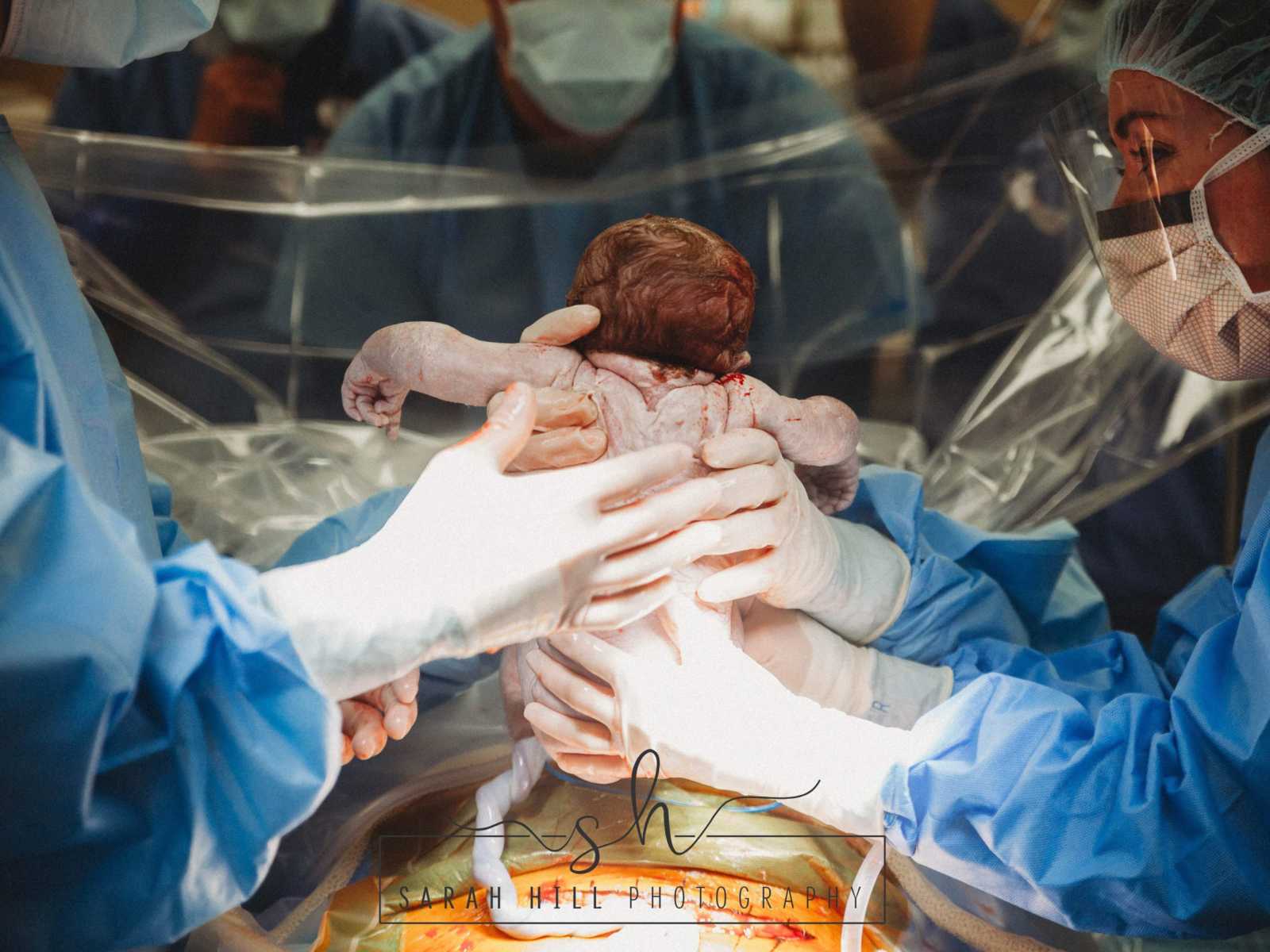 Nurses holding up newborn c-section baby whose umbilical chord is still attached