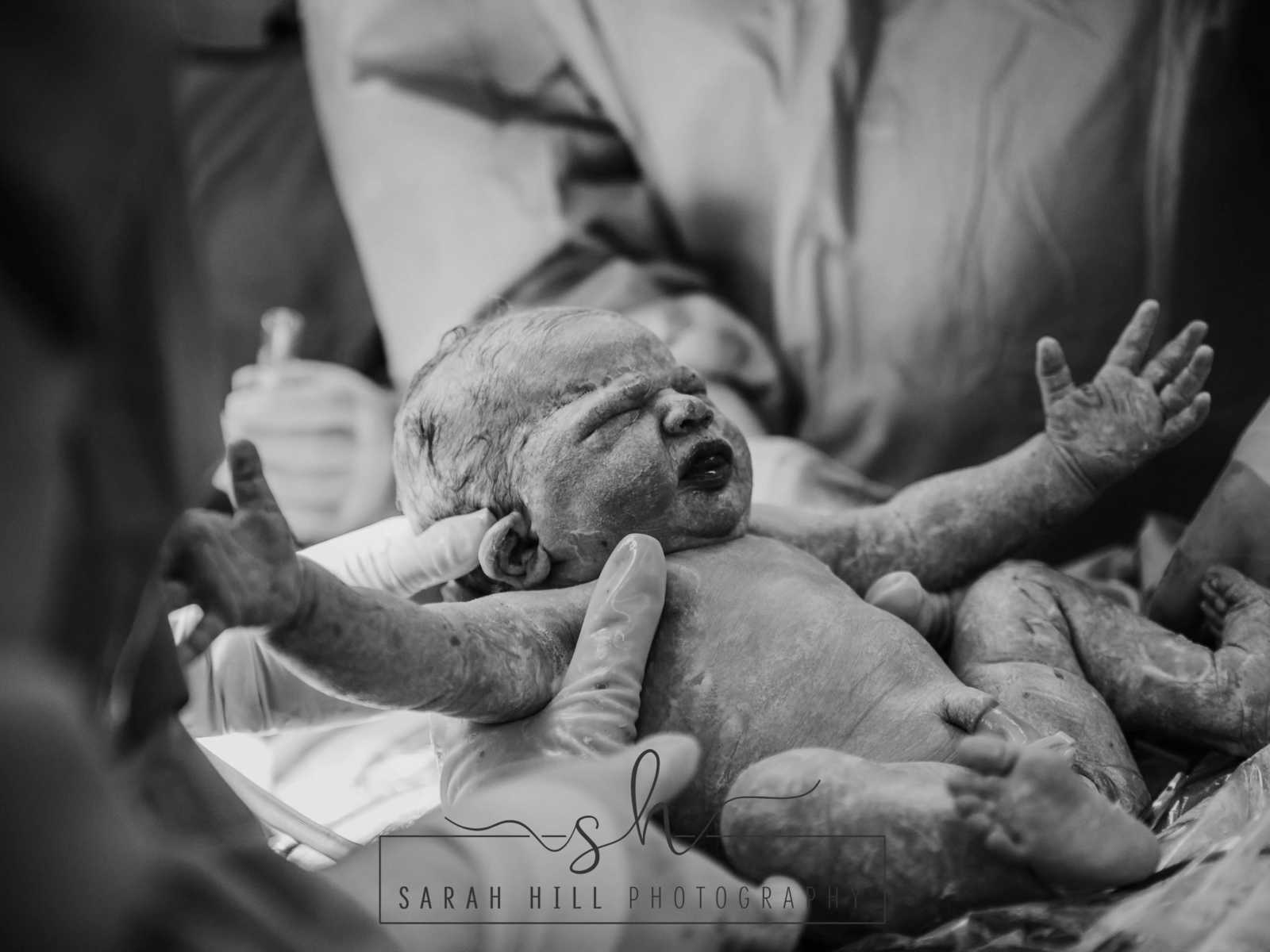 Close up of newborn who was delivered via c-section