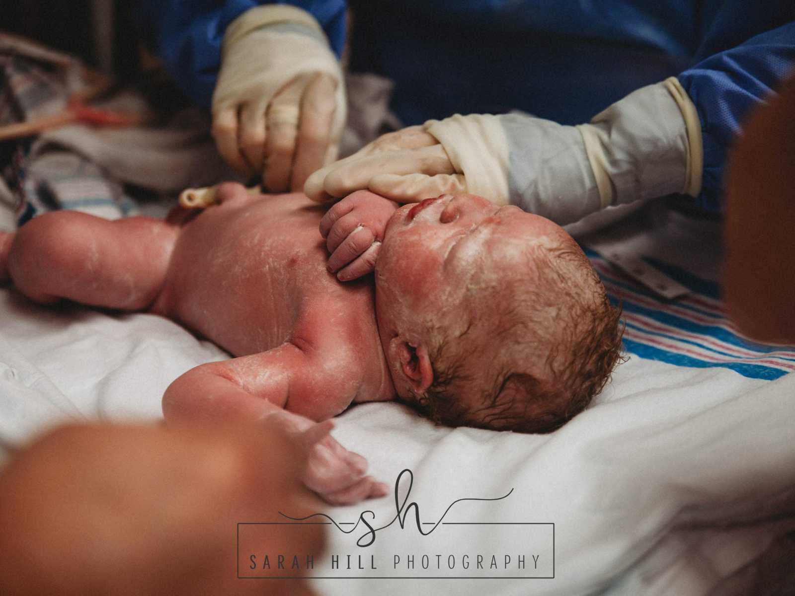 Newborn c-section baby lies on blanket while doctors tend to it