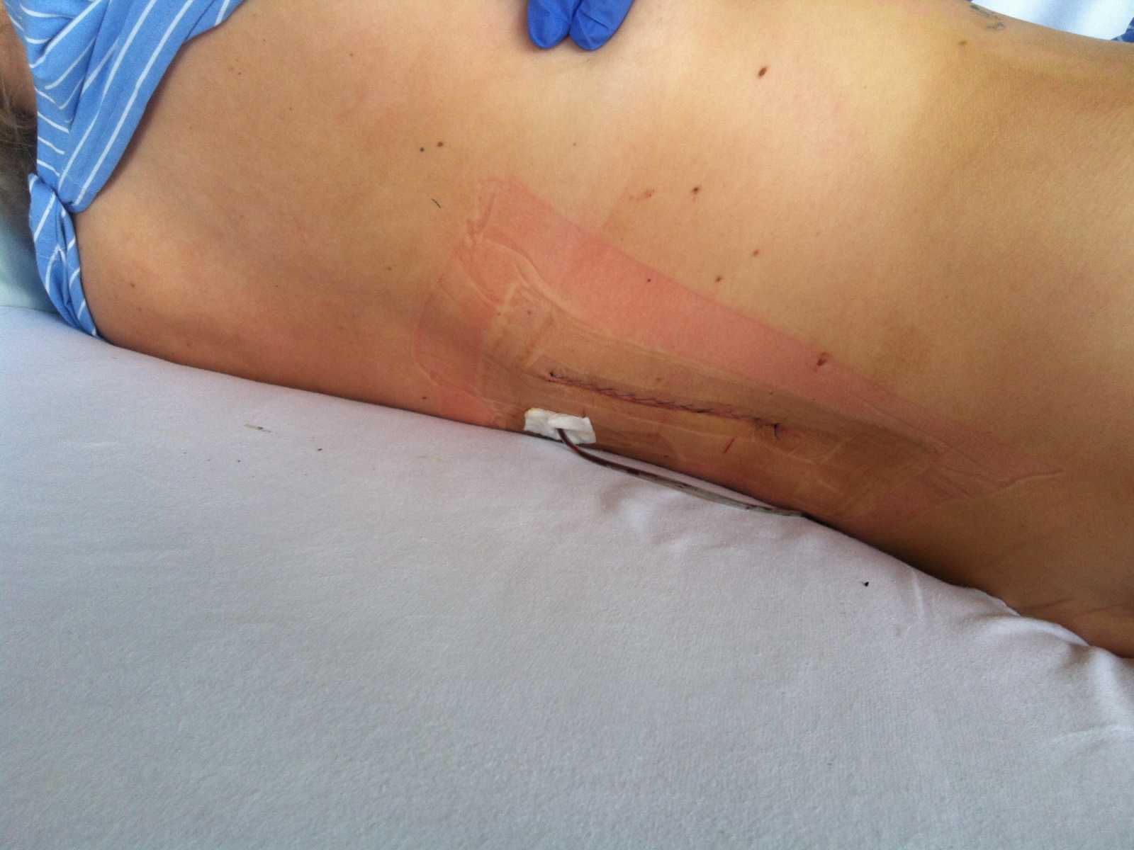 Close up of scar on paraplegic woman's back