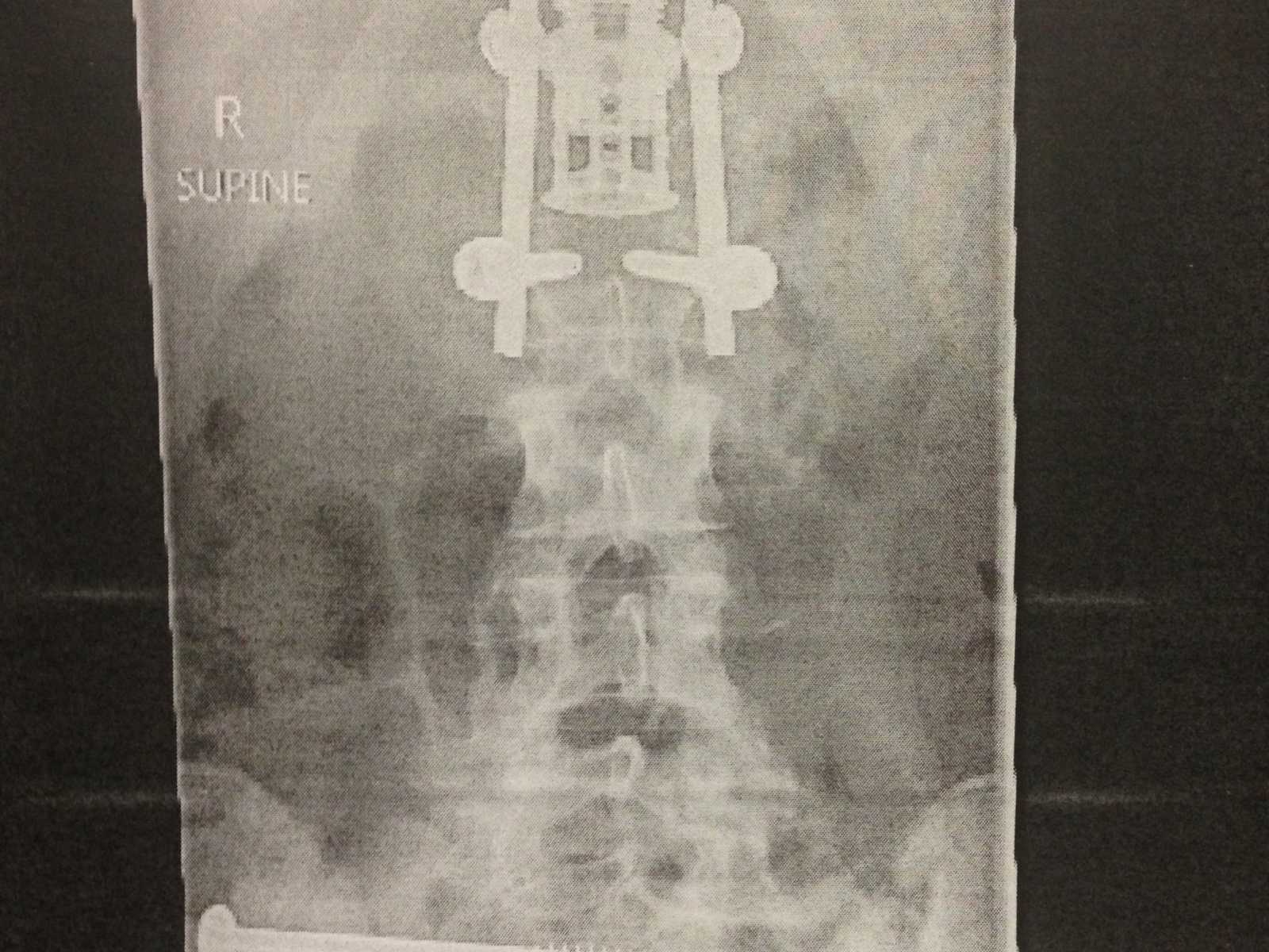 X-ray of paraplegic woman's spine