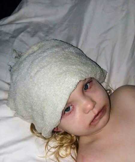 Little girl whose face blistered from makeup kit lying in bed looking up with towel over forehead 