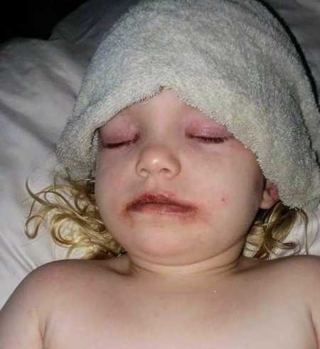 Little girl whose face was blistered from makeup kit sleeping with towel over her forehead