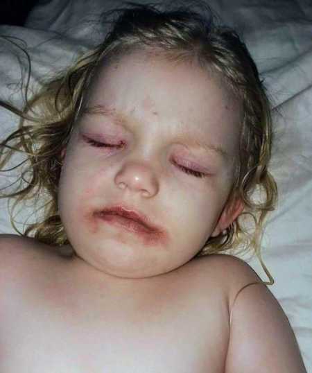 Little girl whose face was blistered from makeup kit sleeping