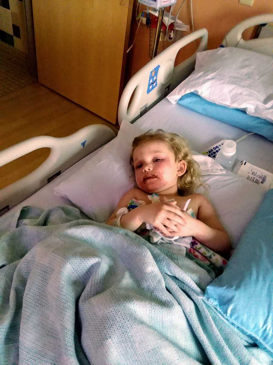 Little girl whose face blistered from using makeup kit lying in hospital bed