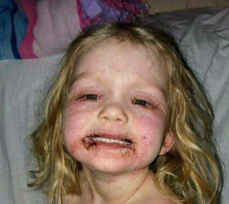 Toddler's face with blisters all over it from using children's makeup kit