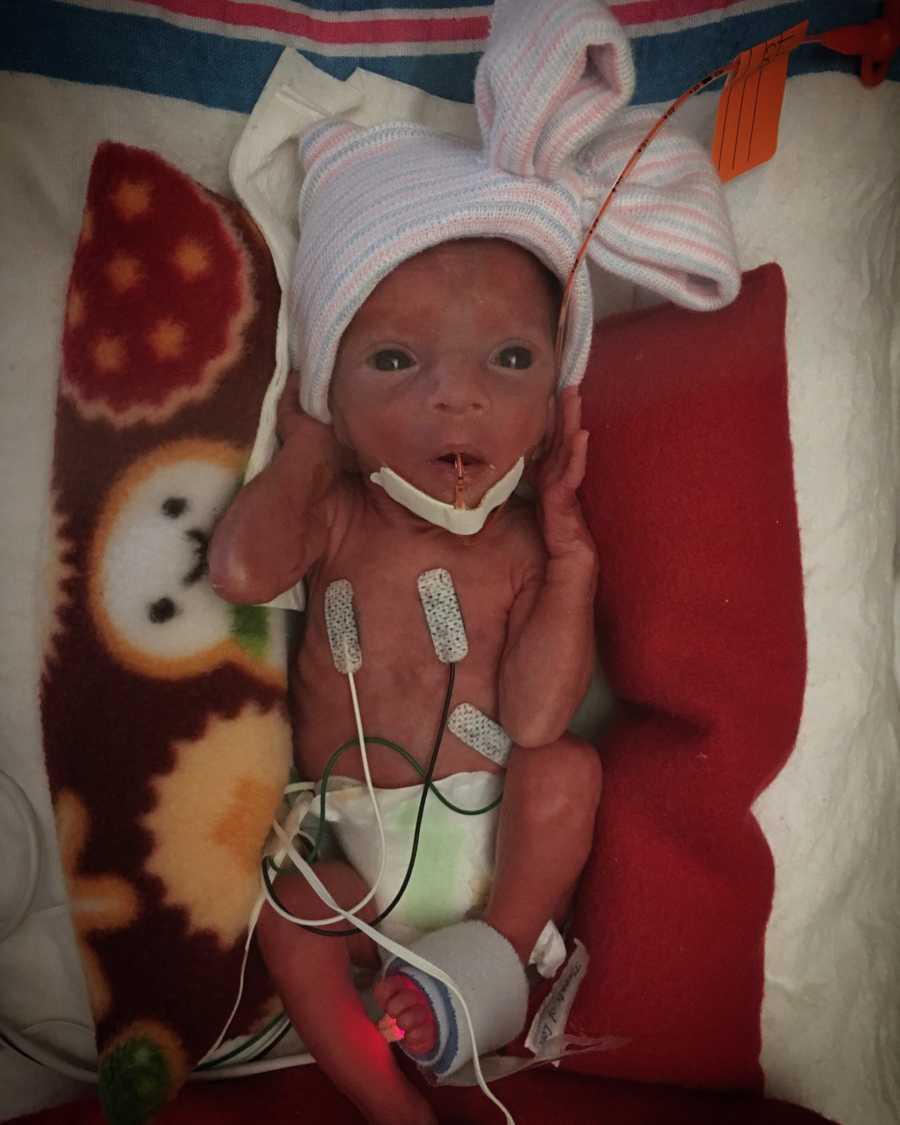 Newborn baby who weighs two pounds lying on her back with wires attached to her body