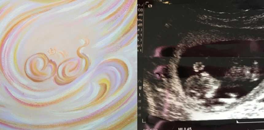 Painting of ultrasound in color next to black and white ultrasound