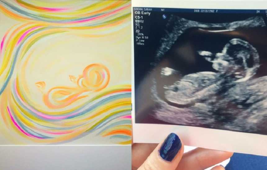 Side by side of ultrasound painting next to woman holding black and white ultrasound 