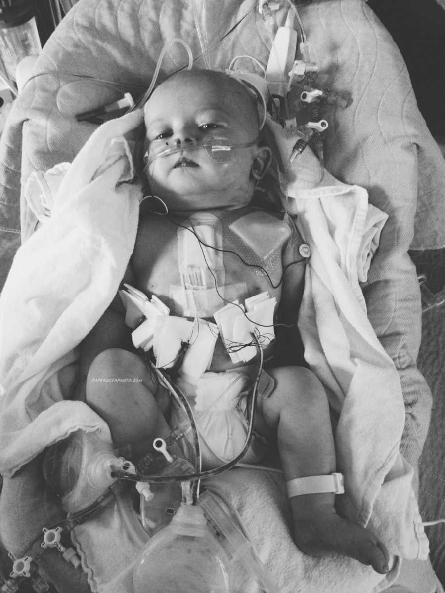 Aerial view of baby lying down with all sorts of wires and gauze attached to him after second heart surgery