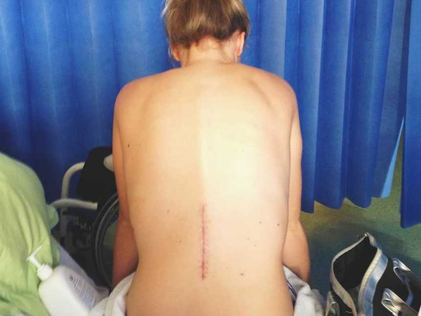 Shirtless paralyzed woman sitting down leaned over with a scar down her lower back 