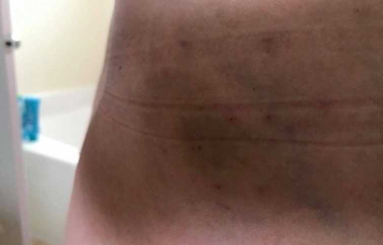 Close of of woman's bruised stomach from IVF injections