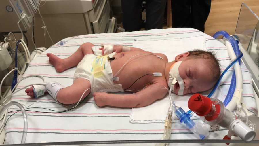 Baby girl with spina bifida and chiari malformation lies in hospital after surgery with wires attached to her body