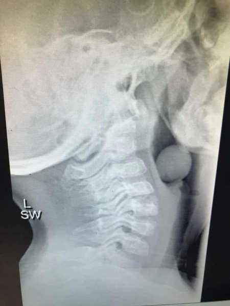 X-ray of grape lodged in 5 year olds airway