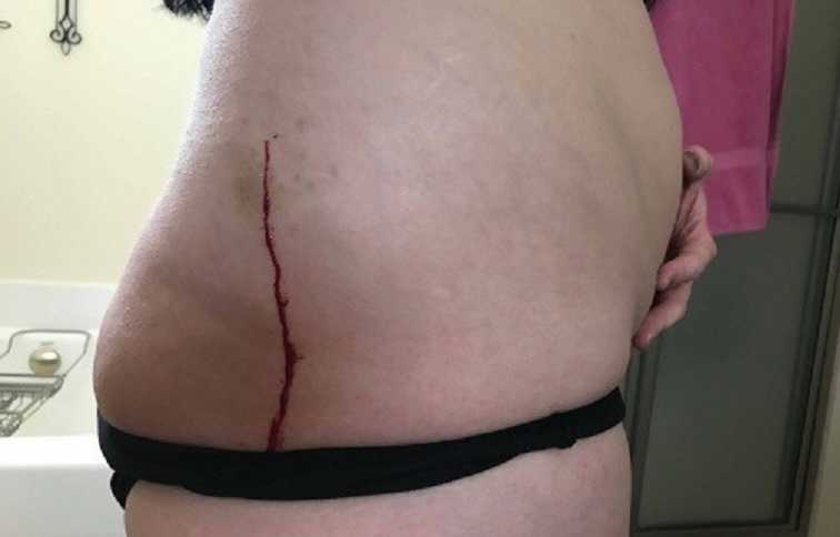 Side of woman who has blood running down her stomach from IVF injection