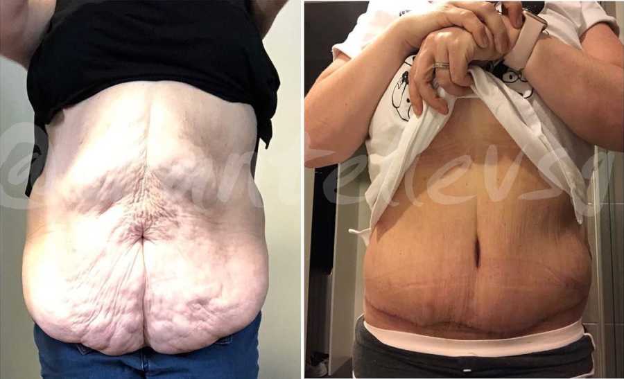 Woman's stomach before and after losing weight with excess skin