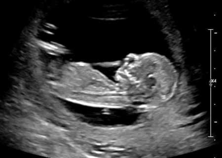 Ultrasound of baby who will not make it