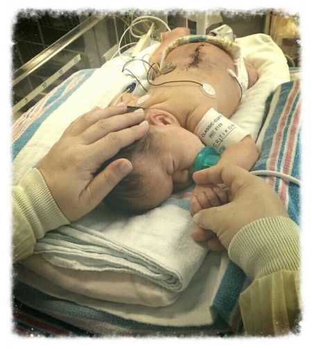 Newborn who will have to use a wheelchair her whole life lying on her stomach in hospital with scar down her back