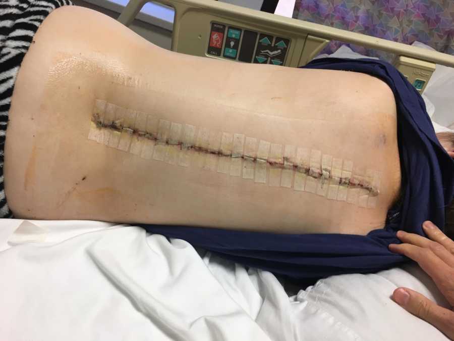 Scar on back of girl with special needs after spinal surgery