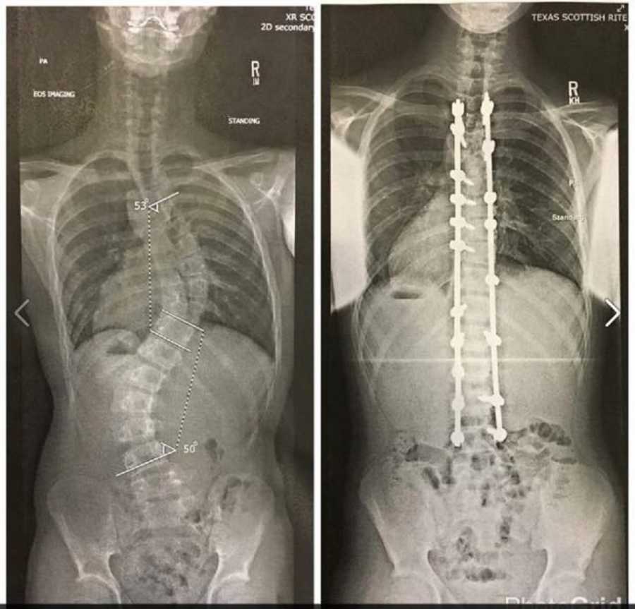 X-ray of girl with special needs spine
