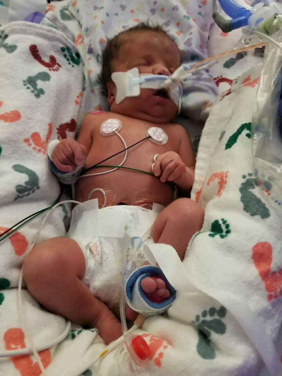 Newborn baby who was delivered in unexpected C-section lying in NICU with wires attached to her body