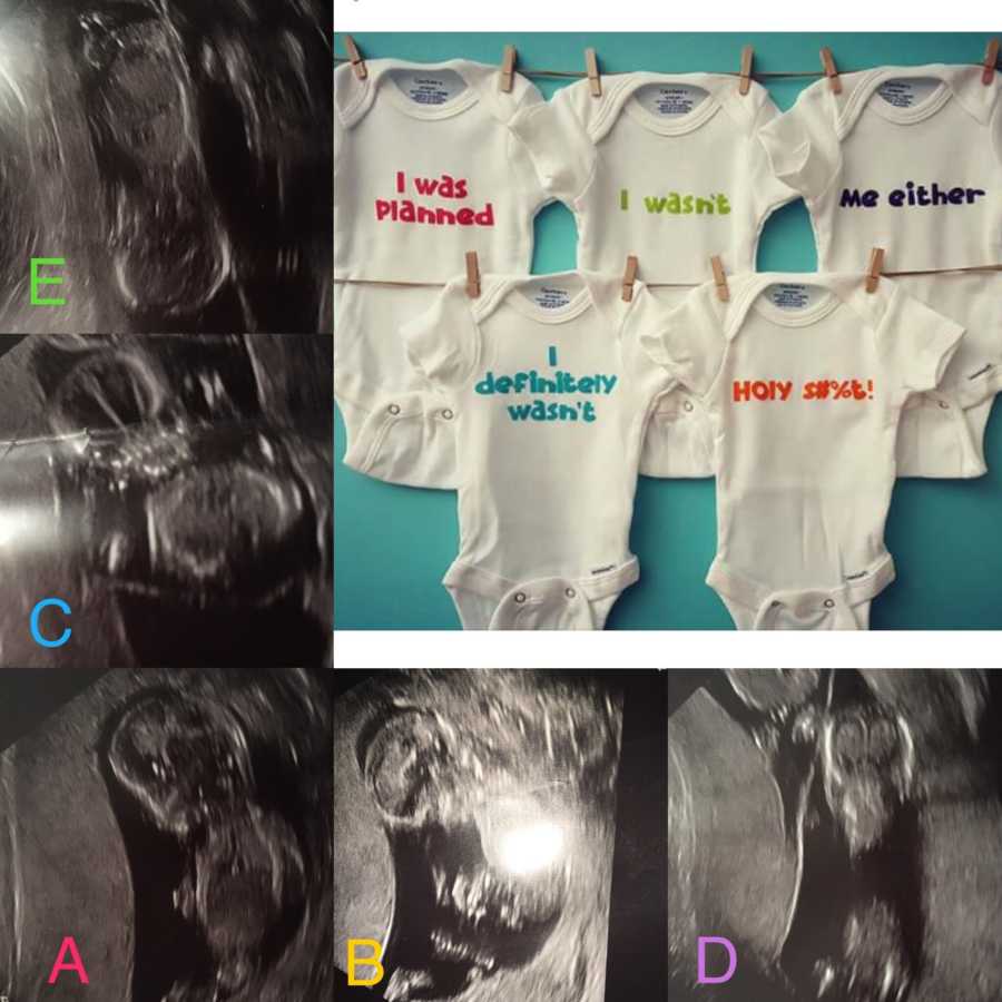 Ultrasound of quints and five onesies