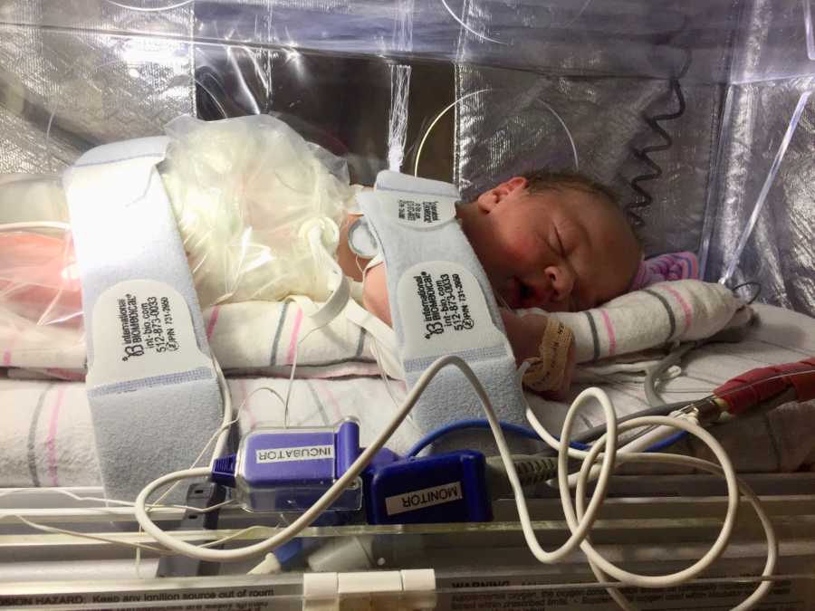 Baby with spina bifida and Chiari malformation asleep in NICU