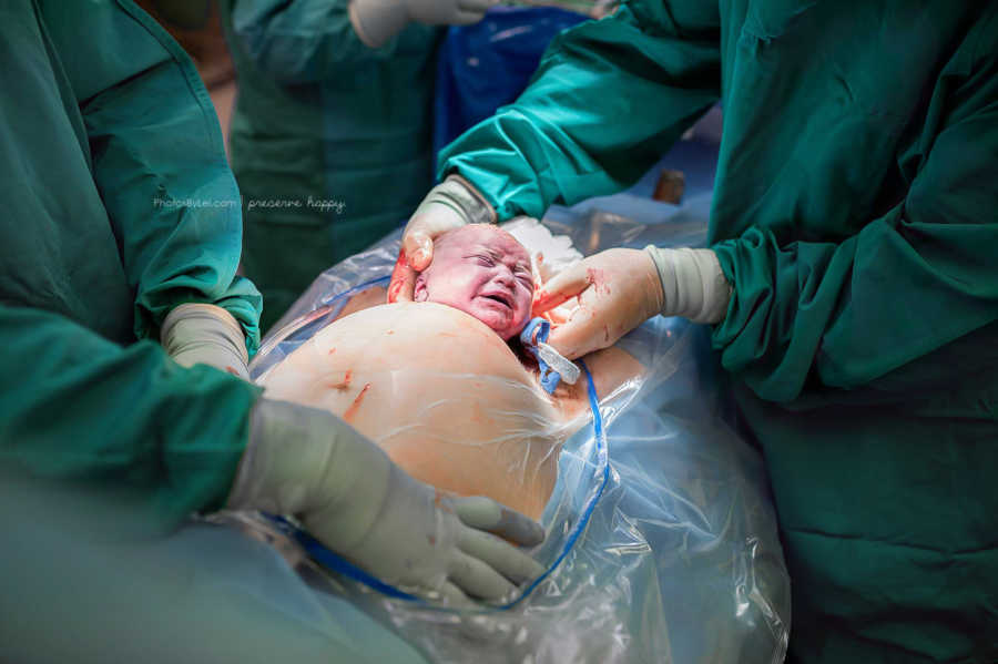 Doctors's delivering baby through c-section