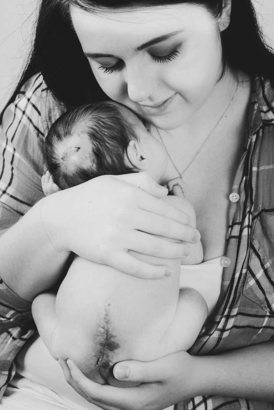 Mother holds baby with spina bifida and Chiari malformation close to her chest 