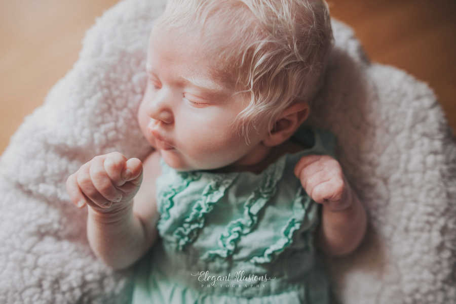 Albino newborn with bright white hair sleeps in green onesie with ruffles