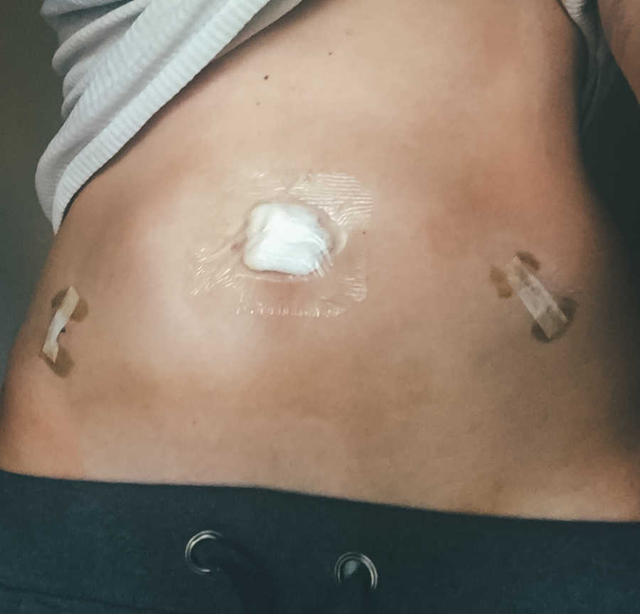 Stomach of photographer who struggles with infertility with bandages on it from fertility treatments