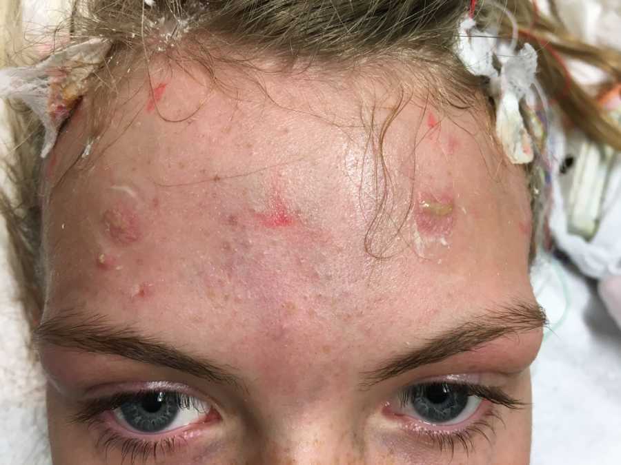Close up of teen with focal seizures after brain surgery with scabs all over her forehead