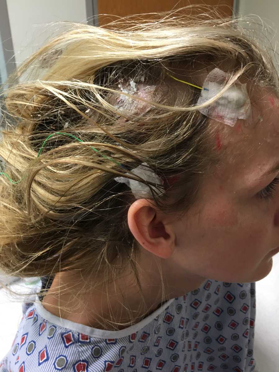 Close up of teen with focal seizures head after brain surgery