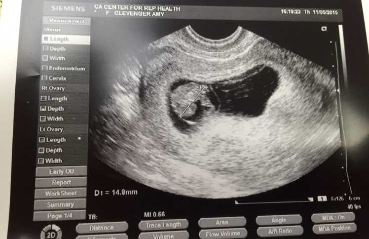 Ultrasound of baby conceived naturally 3 months after IVF baby was born
