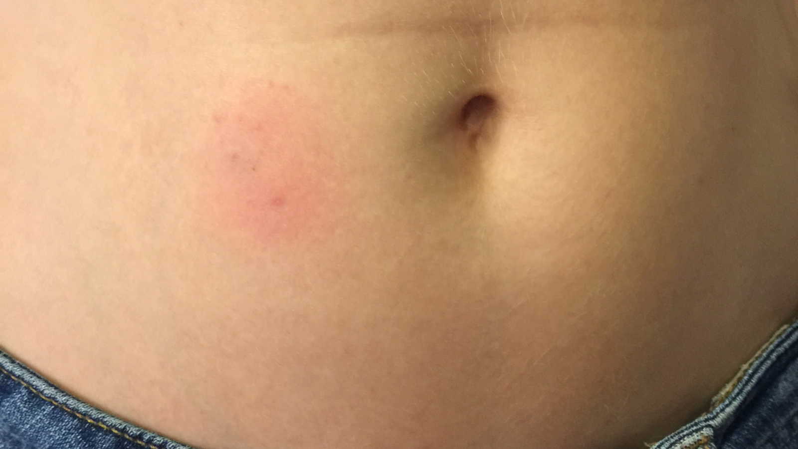 Close up of woman's stomach with red patch from IVF treatment