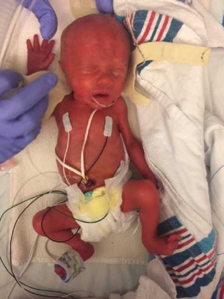 Newborn sleeping in NICU with wires attached to him