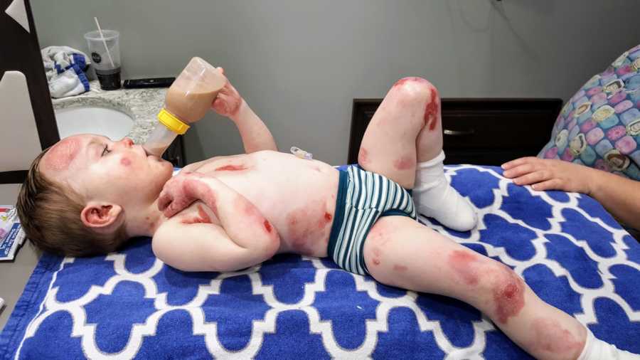 Toddler with rare skin disease lies down drinking out of bottle and body is covered in red spots