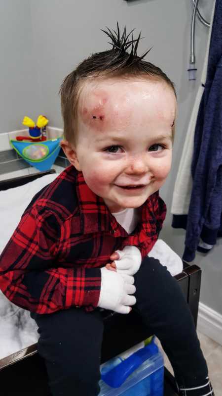 Toddler with rare skin condition and red marks on forehead sits smiling