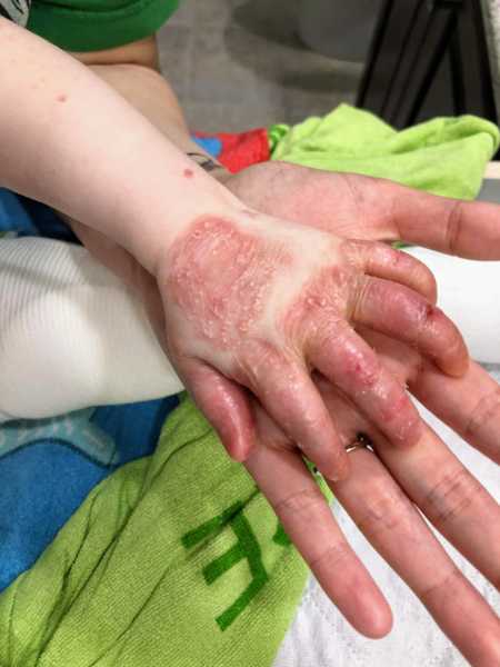 Little boy with rare skin disease rests hand that's covered in red spots in mother's hand