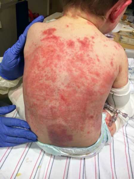 Close up of toddler's back who has rare skin disease covered in red splotches