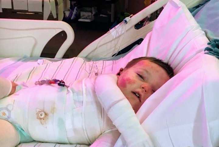 Toddler with rare skin disease sleeps in hospital bed covered in white bandages and red spots on his face