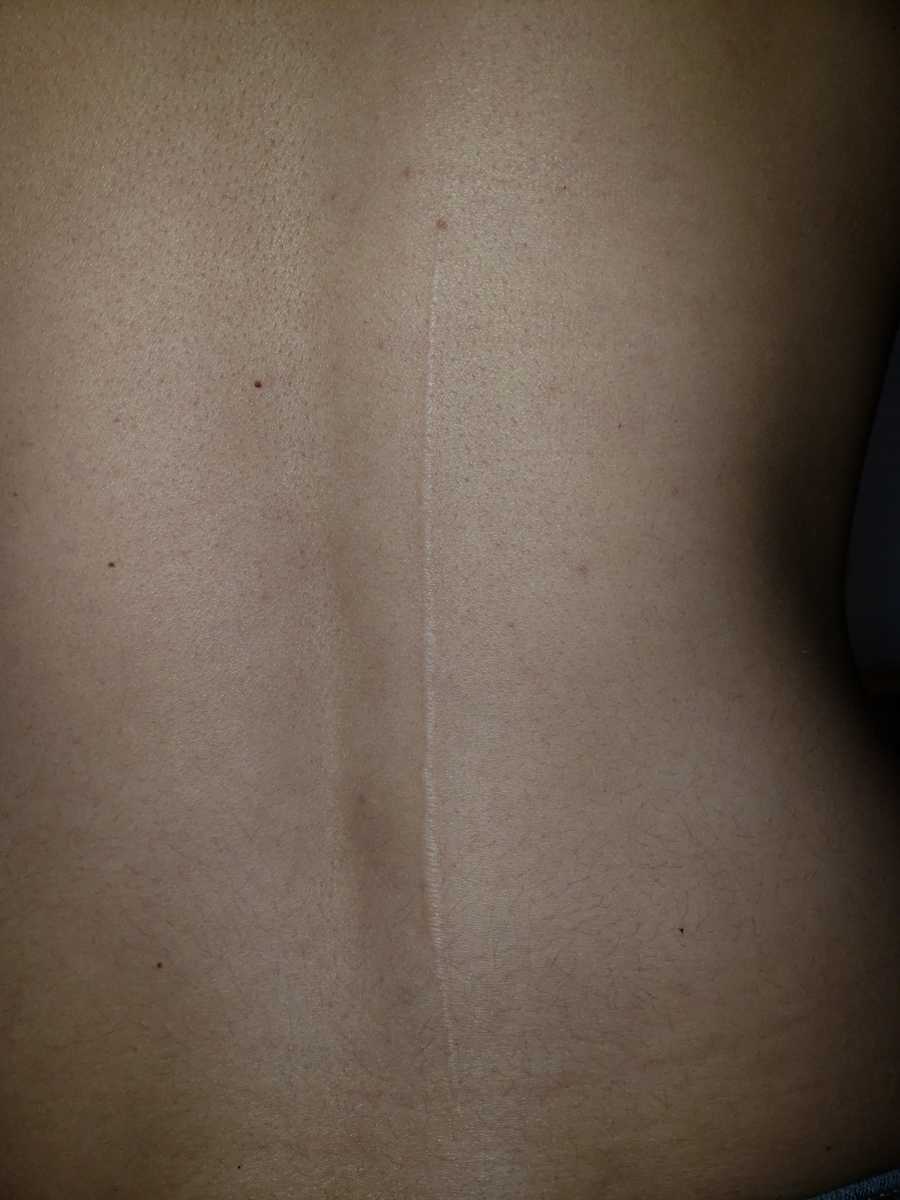 Scar on woman's back from boyfriend cutting her with box opener