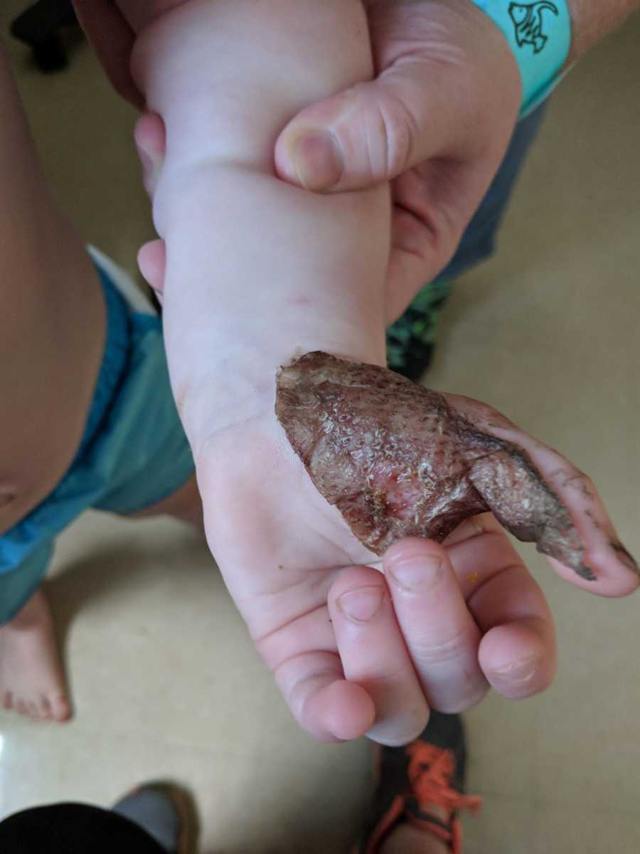 Hand of toddler who had a skin graft after being burned by treadmill