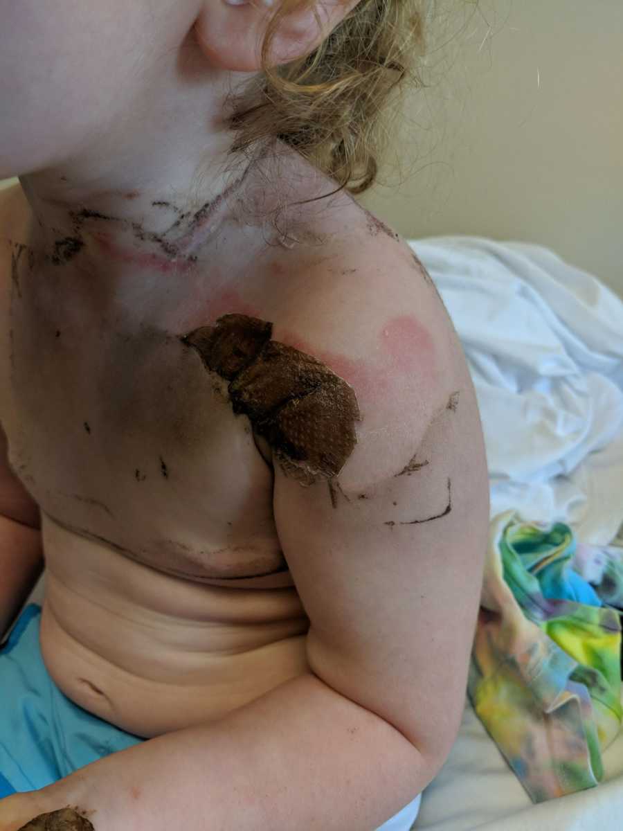 Burns on toddlers shoulder and neck after being cleaned and having skin graft